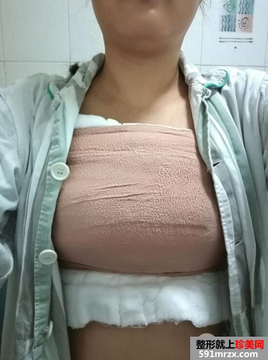 缩胸手术真实案例前后对比图案例分享 我的胸太大我很
